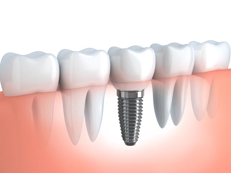 Dental Implants  Schwenksville, PA 